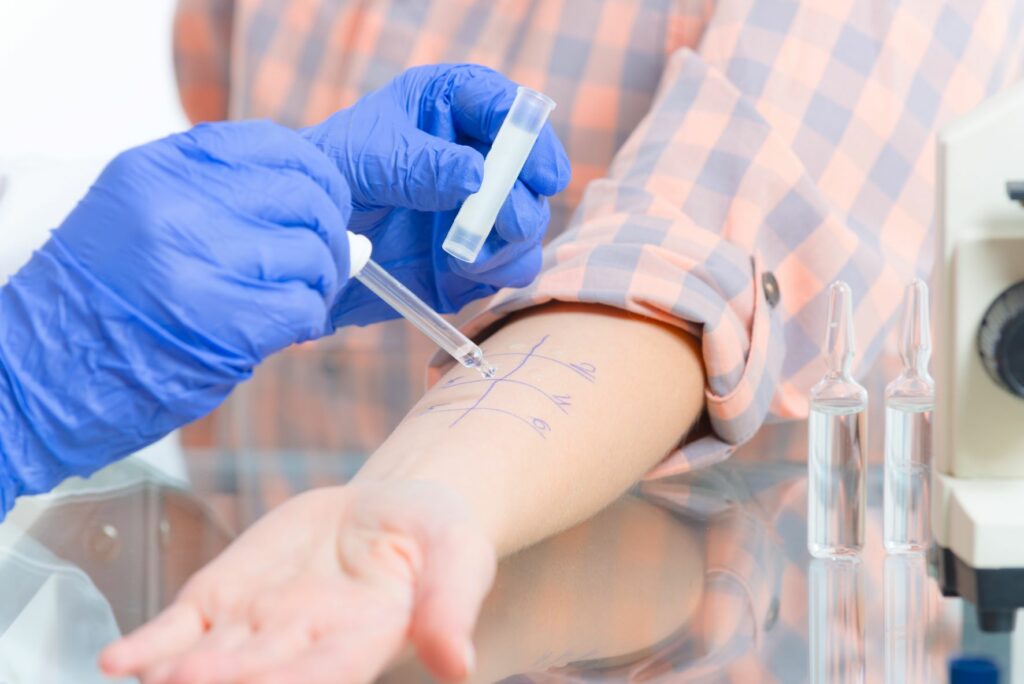Fotografia da realização de testes cutaneos com a colocação das gotas de alergéneos na pele. Este teste é uma forma de diagnosticar a alergia a gatos
