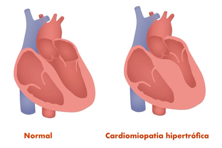 cardiomiopatia hipertrófica felina_2